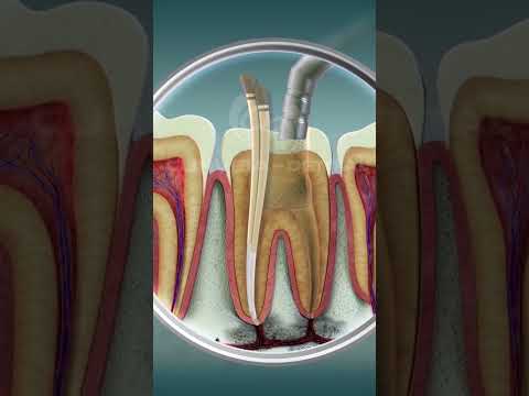 Root Canal Treatment | Curveia Dental I RCT
