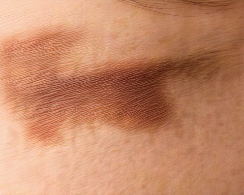 Breakthrough in Melanoma Treatment: OPM-101 Offers Hope for Resistant Cases Breakthrough in Melanoma Treatment: OPM-101 Offers Hope for Resistant Cases
